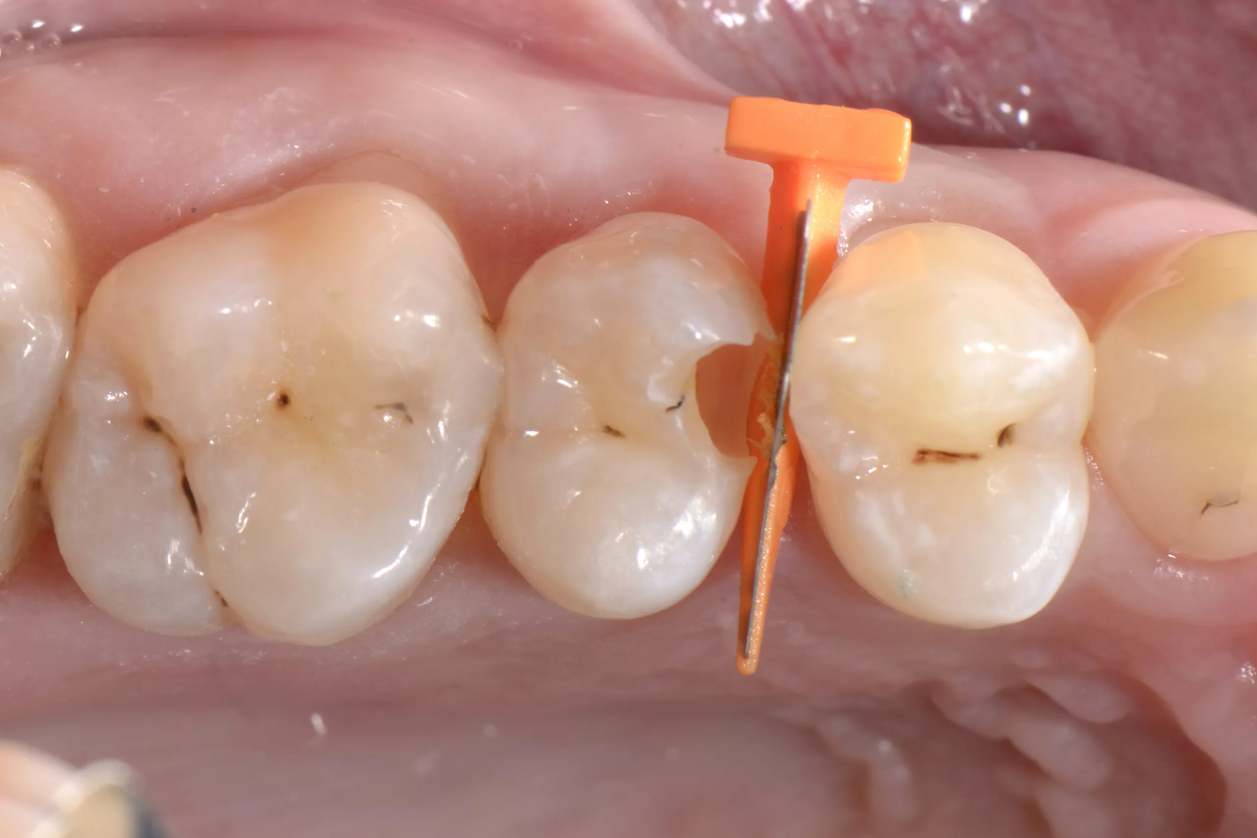 formation odontologie restauratrice techniques directes 4